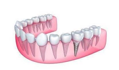 太仓单颗种植牙多少钱一颗？