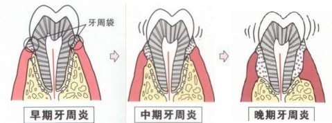 如何才能诊断是否患有牙周炎